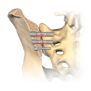 silex-image-with-coating